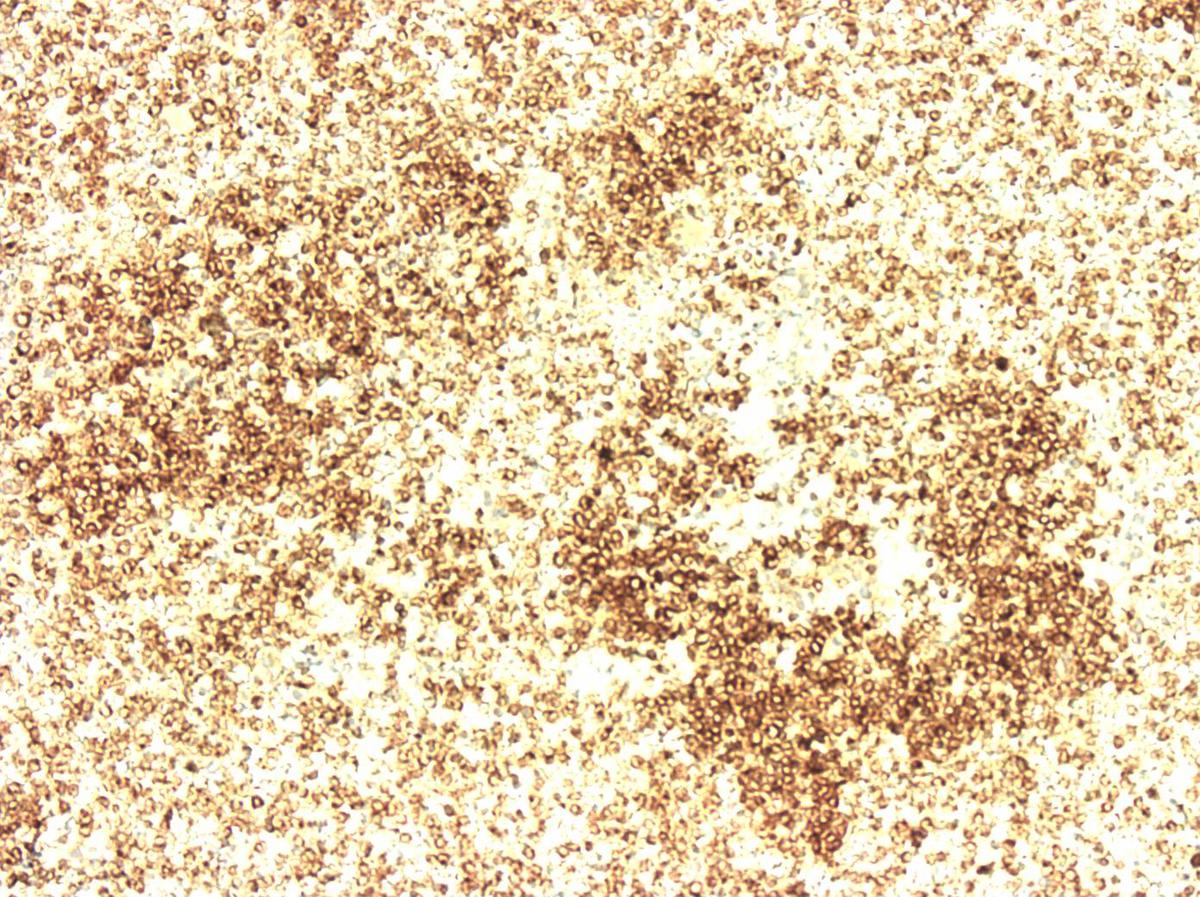 CD117 on clot section
